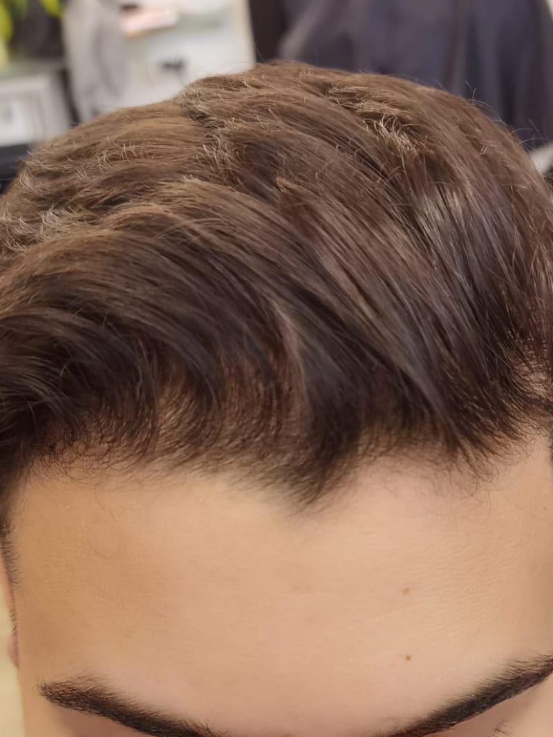 Androgenetische Alopezie — Nachher