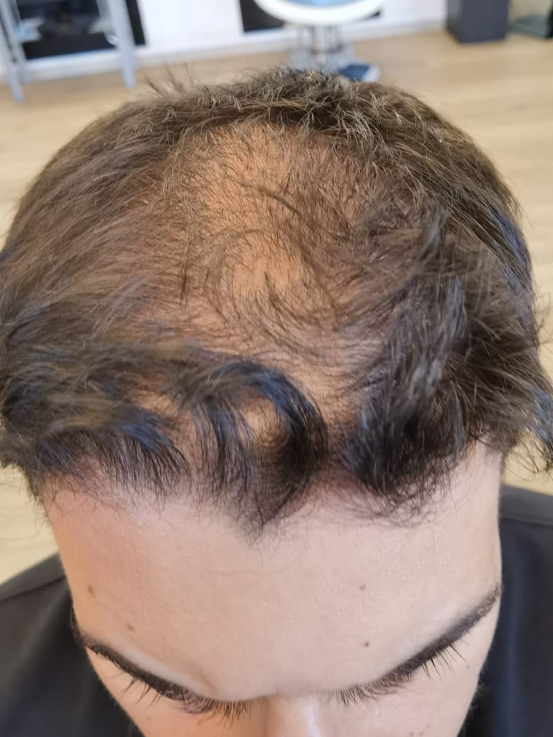 Androgenetische Alopezie — Vorher