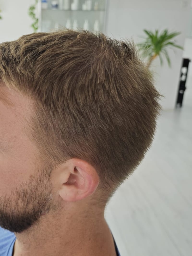 Männlicher Haarausfall — Nachher