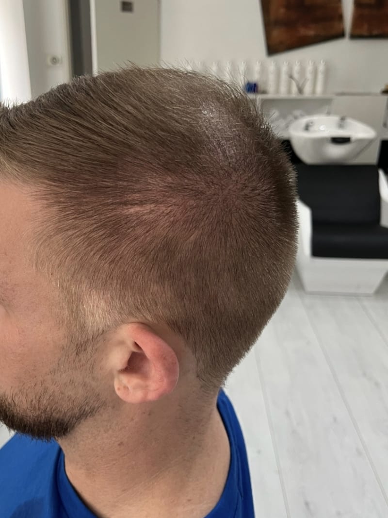 Männlicher Haarausfall — Vorher